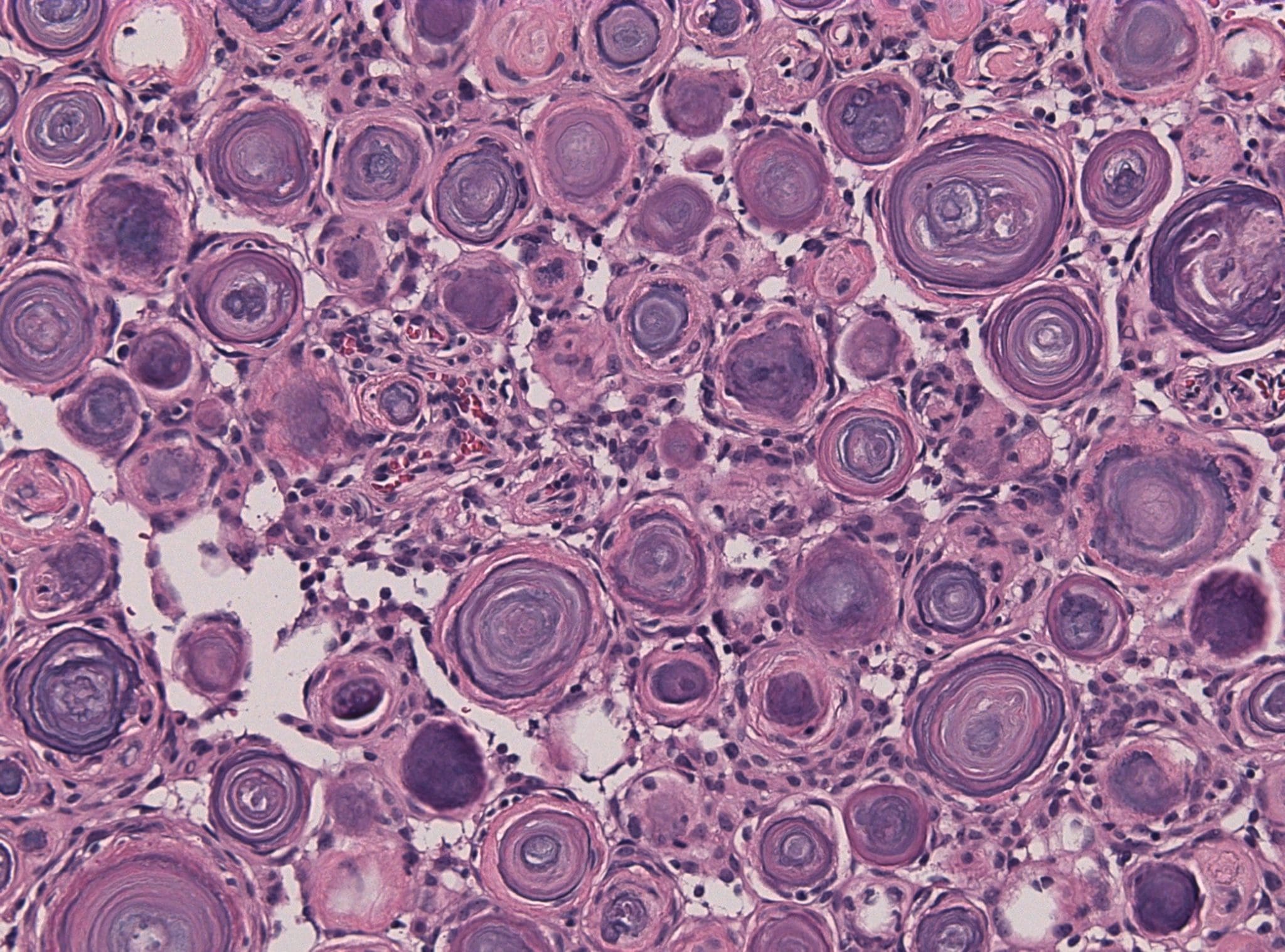 neuro-pathology of tumor