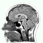 MRI scan of brain