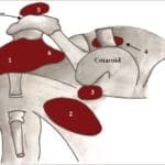 site of joint steroid injection