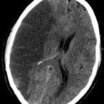 ischemic stroke