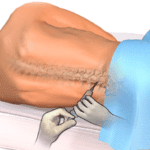 site of lumbar puncture